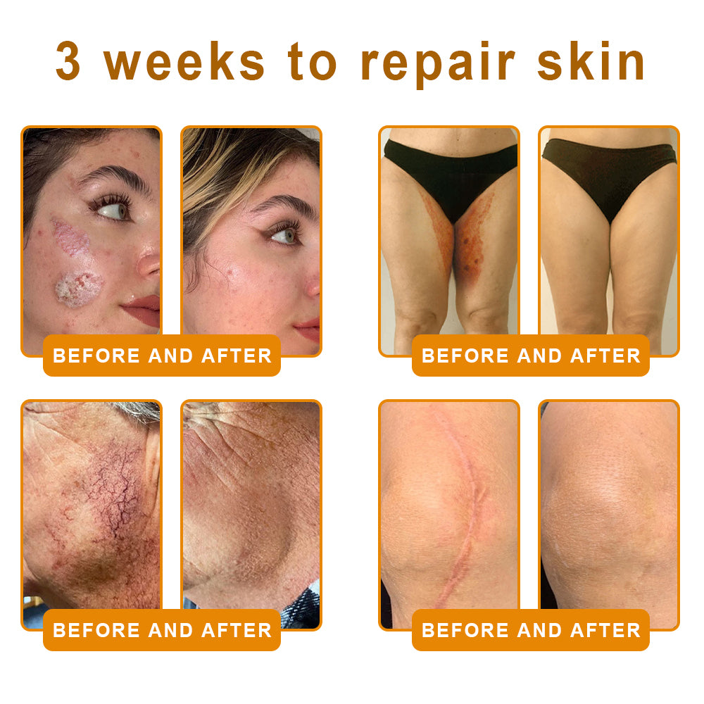 𝐋𝐎𝐕𝐈𝐋𝐃𝐒™ 𝐁𝐞𝐞 𝐕𝐞𝐧𝐨𝐦 𝐀𝐥𝐥-𝐢𝐧-𝐎𝐧𝐞 𝐂𝐫𝐞𝐚𝐦–🌸 Anti-aging,Hydrating, Skin Repair, Even Tone, Acne and Dark Spot Treatment, Wart and Mole Removal, Psoriasis Relief