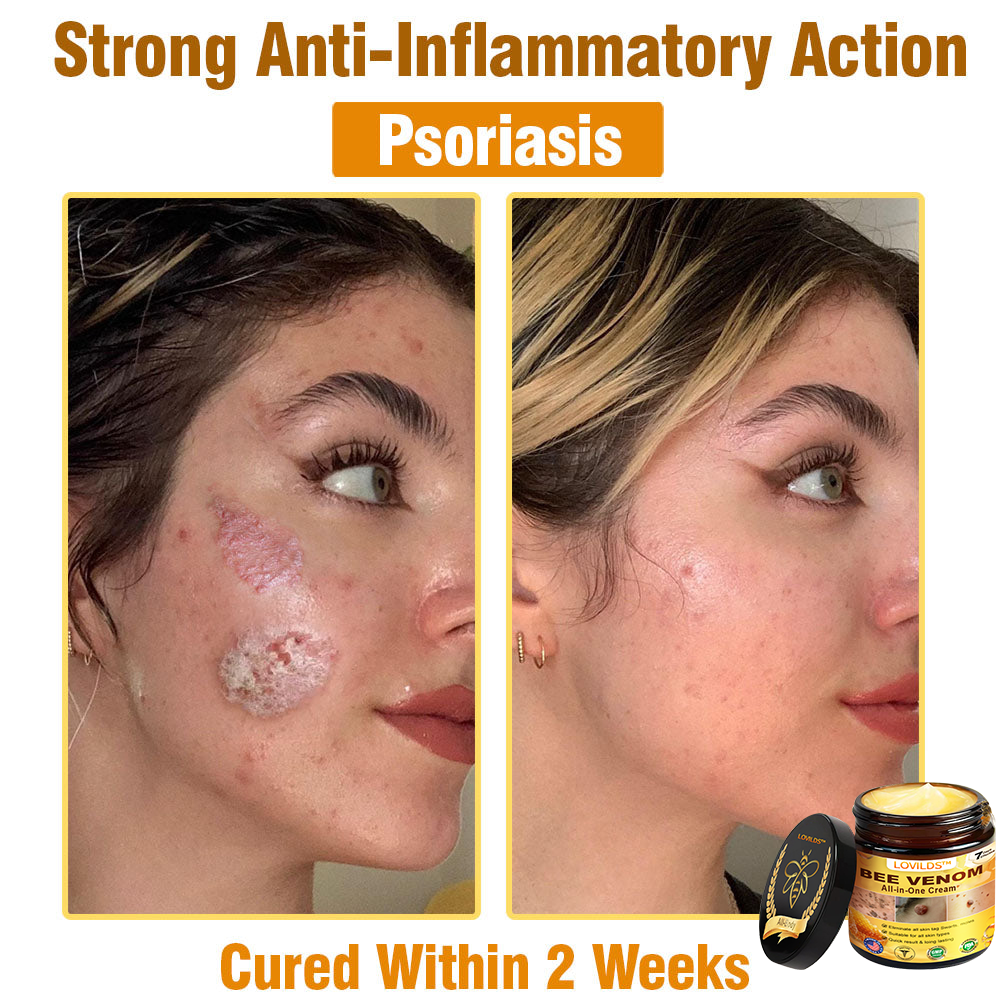 𝐋𝐎𝐕𝐈𝐋𝐃𝐒™ 𝐁𝐞𝐞 𝐕𝐞𝐧𝐨𝐦 𝐀𝐥𝐥-𝐢𝐧-𝐎𝐧𝐞 𝐂𝐫𝐞𝐚𝐦–🌸 Anti-aging,Hydrating, Skin Repair, Even Tone, Acne and Dark Spot Treatment, Wart and Mole Removal, Psoriasis Relief