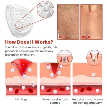 Derma Smooth Skin Tag Removal Patch | 72 Pathces |