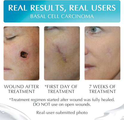NewGel+E Advanced Silicone Gel for Scars - 15 Grams